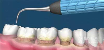 牙齿内侧发黑怎么清除 很简单技巧