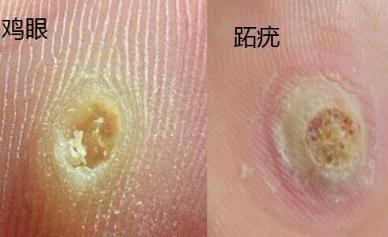 高危型hpv 初期图片