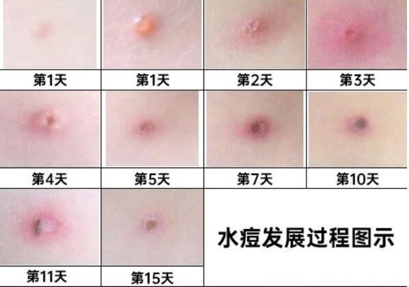 水痘的早期症状图片 水痘4个阶段图片